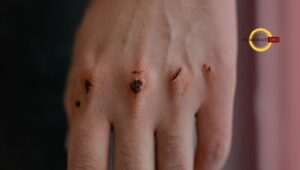 Gangguan integritas kulit/jaringan