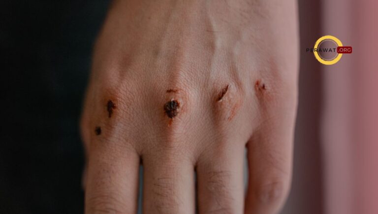 Gangguan integritas kulit/jaringan