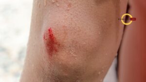 Risiko gangguan integritas kulit jaringan