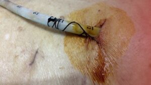 SOP Pemberian obat intrapleura