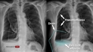 SOP Perawatan Selang WSD