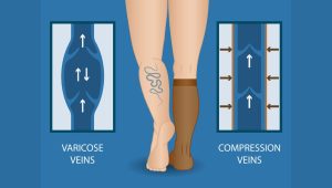 SOP Pemasangan Stoking Elastis