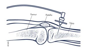 SOP Pemberian Obat Intraoseous